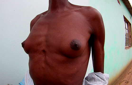Gokwe man with breasts seeks help