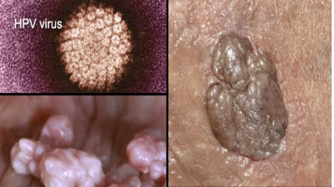 HPV and HIV