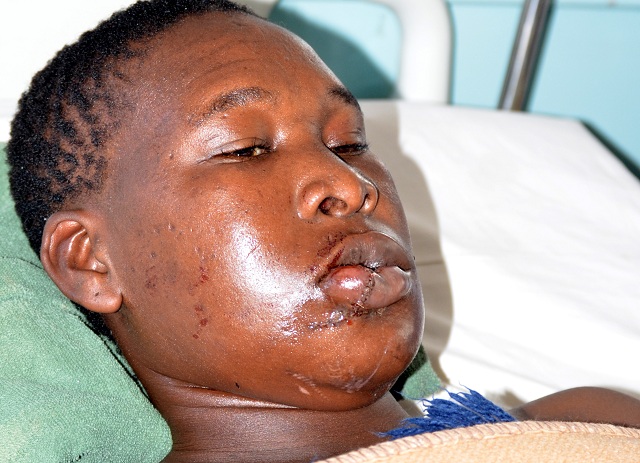 The new look Mbekezeli Ngwenya whose mouth was cut in an accident received plastic surgery at Mpilo Hospital