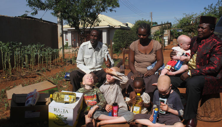 Sekuru Banda confronts albinism