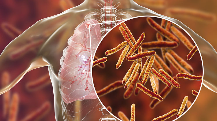 Get screened for TB