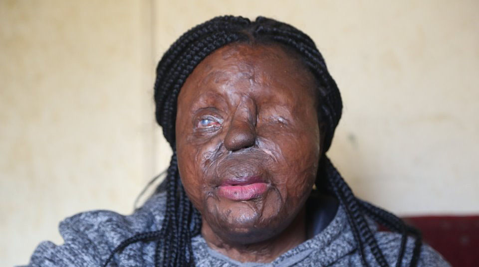 HEARTLESS & SENSELESS. . . acid attack victim fights on