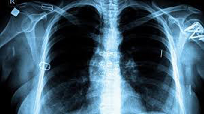 Spare a thought for tuberculosis