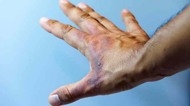 Home treatment for mild burns