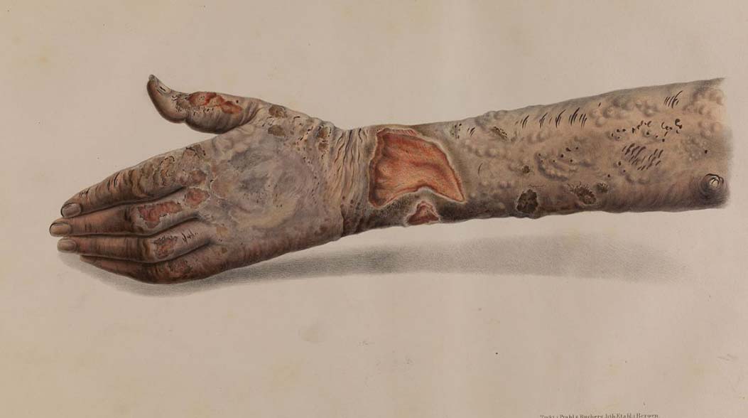 Govt wary over leprosy resurgence