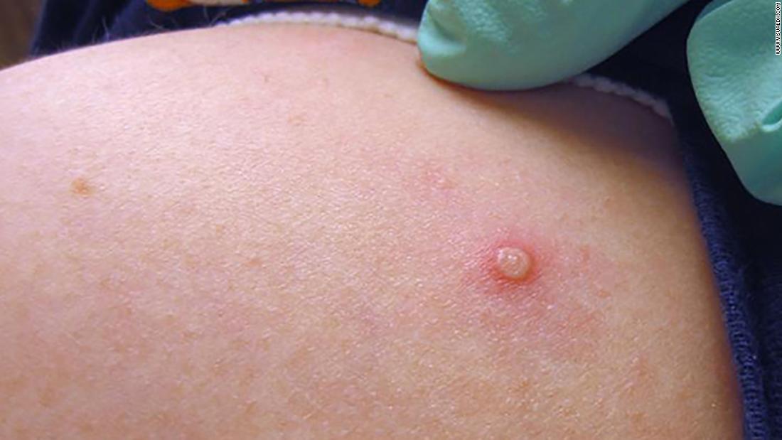 NEW: ‘Be on the lookout for monkeypox’