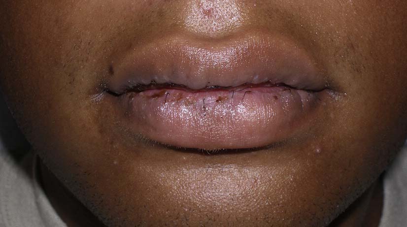 Easy remedies for dry, cracked lips