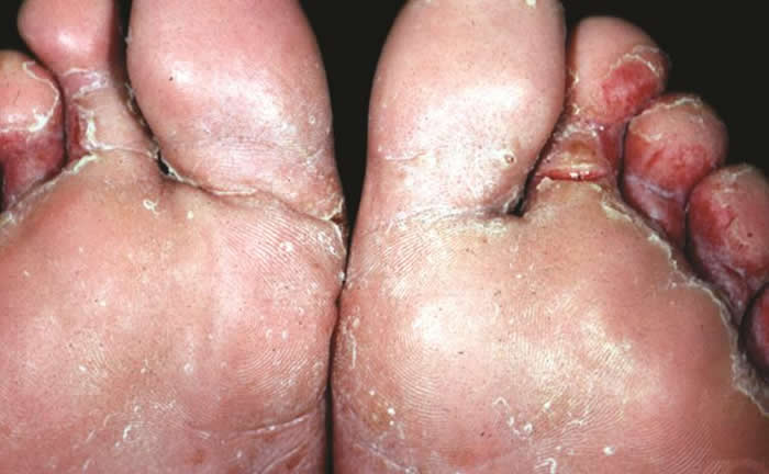 Did you know? Athlete’s Foot (Tinea Pedis)