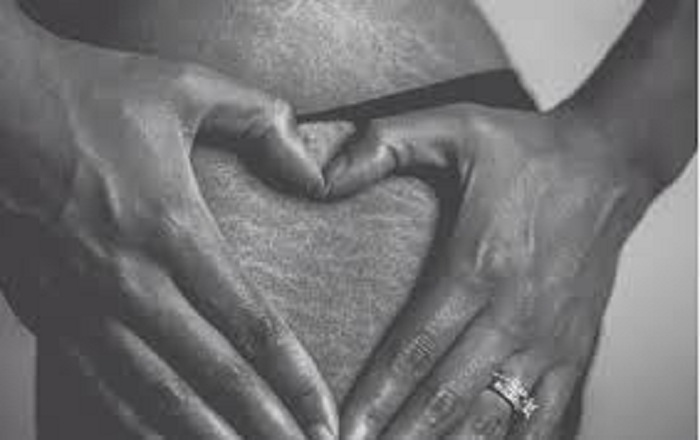 Natural methods of dealing with stretch marks