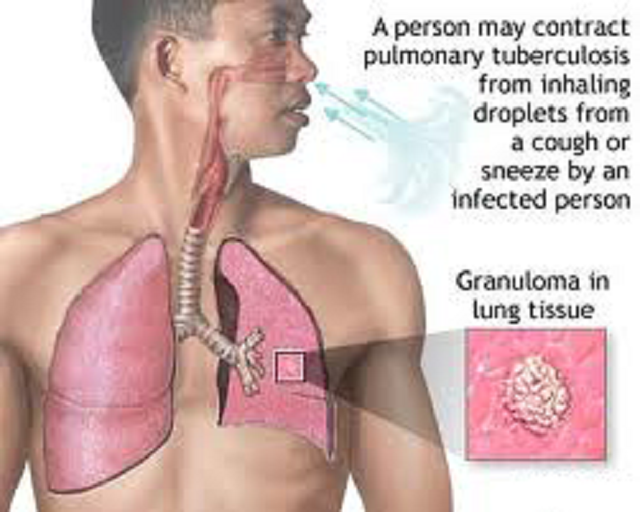 Tuberculosis — Signs, symptoms, treatment and prevention