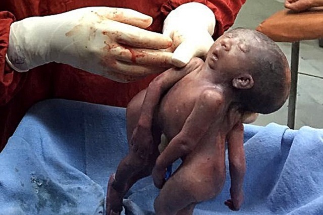 The Siamese twins who shared a FACE