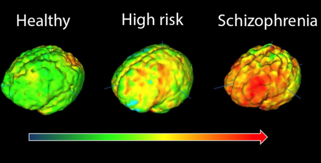 Schizophrenia — Another type of brain disorder