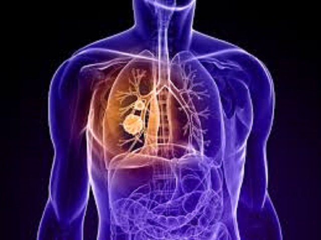 HEALTH PROMOTION: What is COPD?