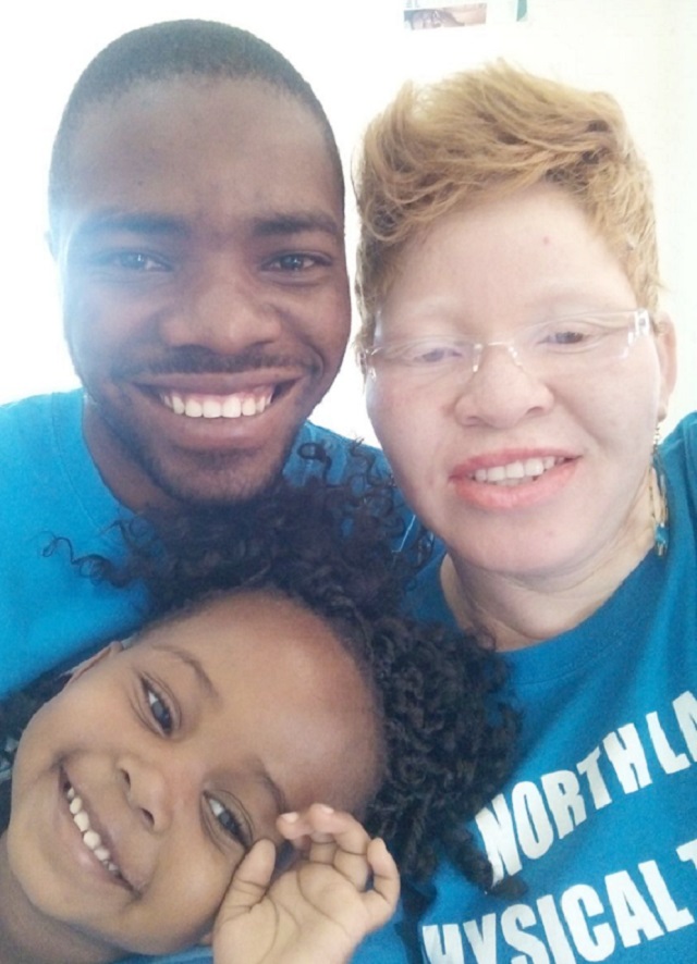 Albinism just a condition, couple bares all