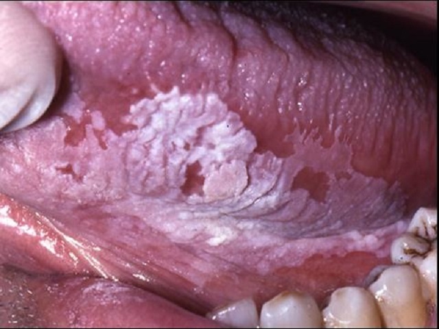 Health Promotion: Understanding Leukoplakia