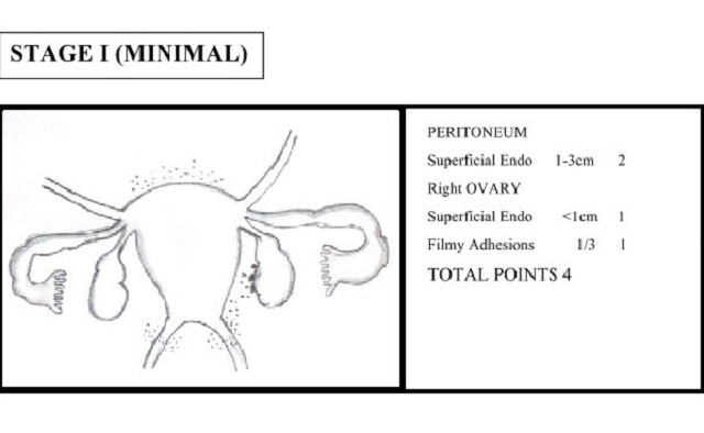 Endometriosis stages and treatment