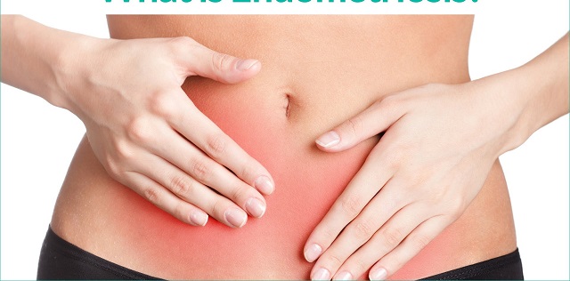 How to support someone with endometriosis
