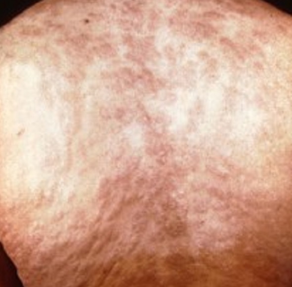 Understanding Syphilis