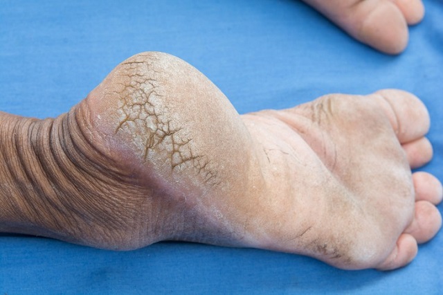 Sweet feet this summer