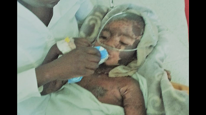 Baby burnt in fireless incident