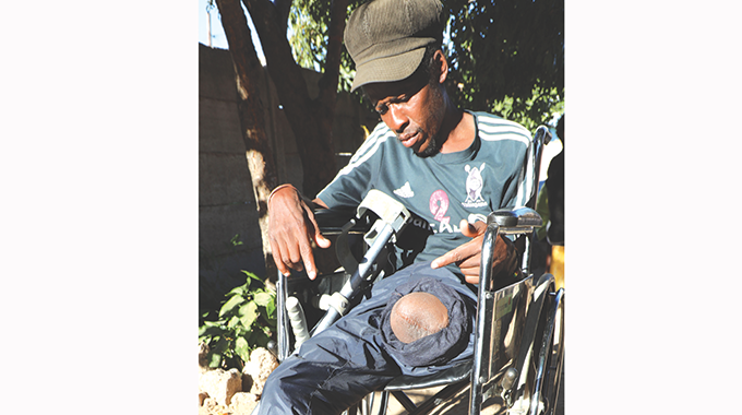 Amputee seeks help