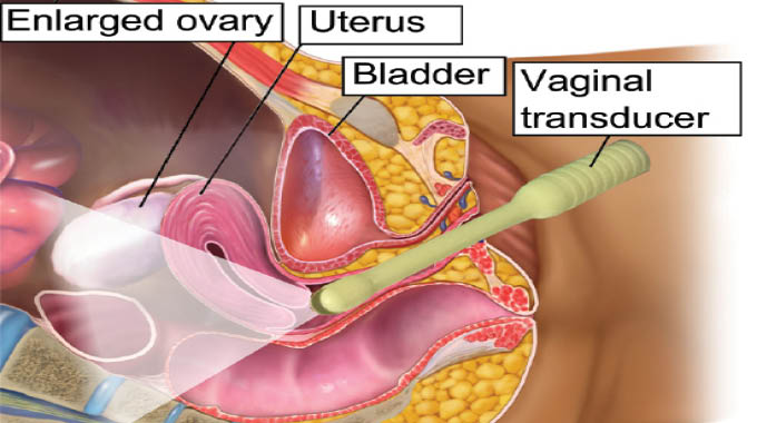 Endometriosis diagnosis