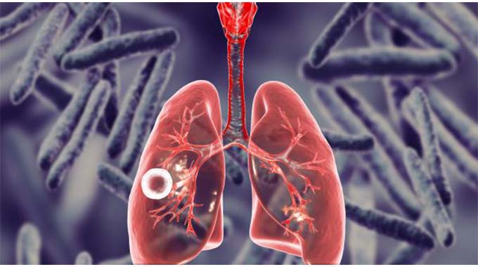 Multi-sector approach vital in ending TB