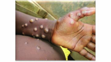 Zimbabwe reports two confirmed cases of Mpox