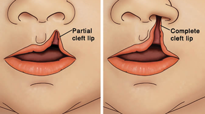 Parirenyatwa Hospital offering free cleft lip and cleft palate surgeries