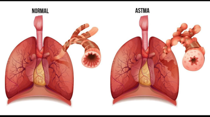 Learning more about asthma