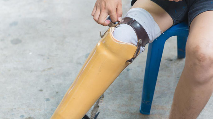 Surgeon amputated wrong leg by mistake