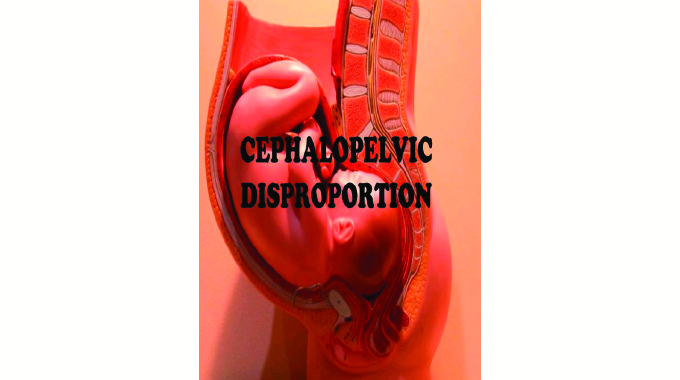 Understanding Cephalopelvic disproportion