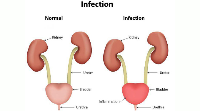 Urinary tract infection