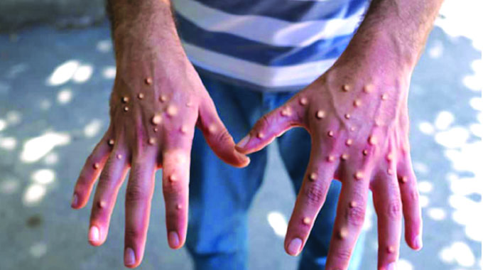 Time to tackle Mpox head-on