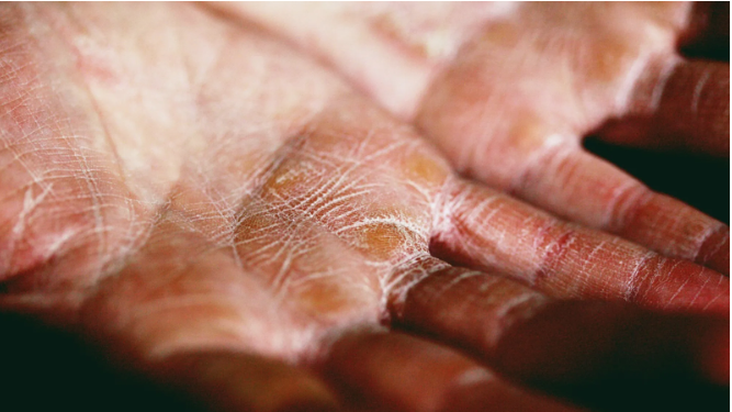 If you’re thinking of trying a bleach bath to treat your eczema, this is what you need to know