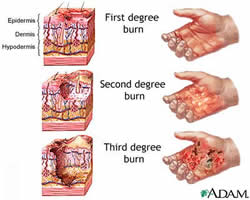 How to deal with burns . . .