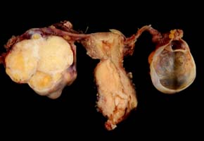 Cervical cancer — silent killer
