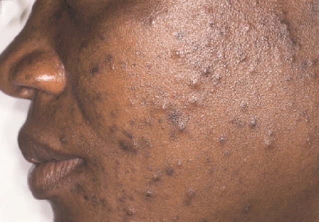 Effects of acne go beyond the skin