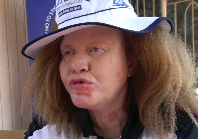 Let’s fight stigma against albinism