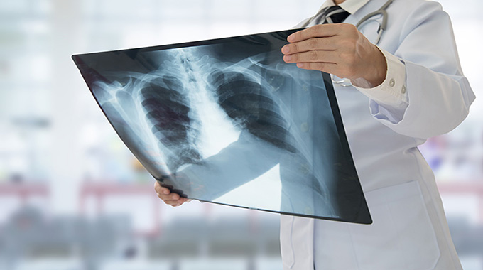 21 600 Zimbabweans diagnosed with TB in 2025