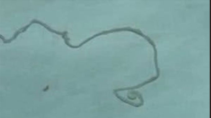 Man has 12cm flesh-eating tapeworm removed which had ‘eaten his brain’ for 15yrs