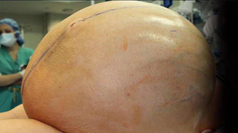 ‘TUMONGOUS’ World’s largest ovarian tumour weighing 110lbs and as heavy as 15-year-old boy removed from 52-year-old woman in India
