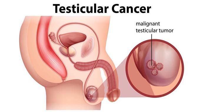 A closer look at testicular cancer