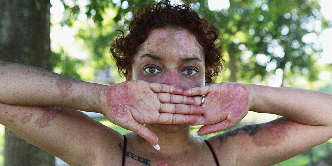 Health: Let’s make lupus visible