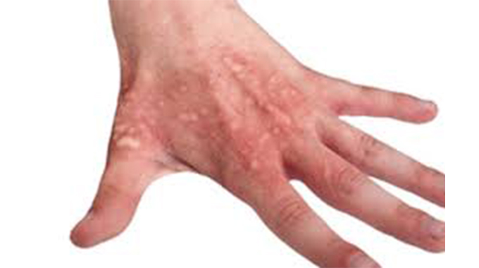 No to burns this winter