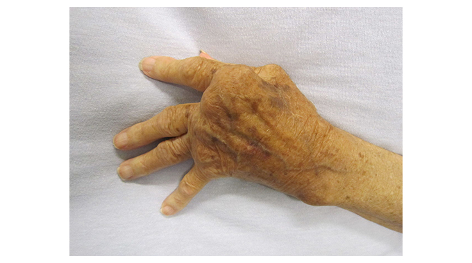 Juvenile arthritis