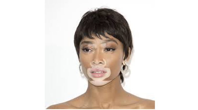Celebrating World Vitiligo Day