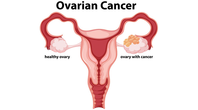 Ovarian cancer