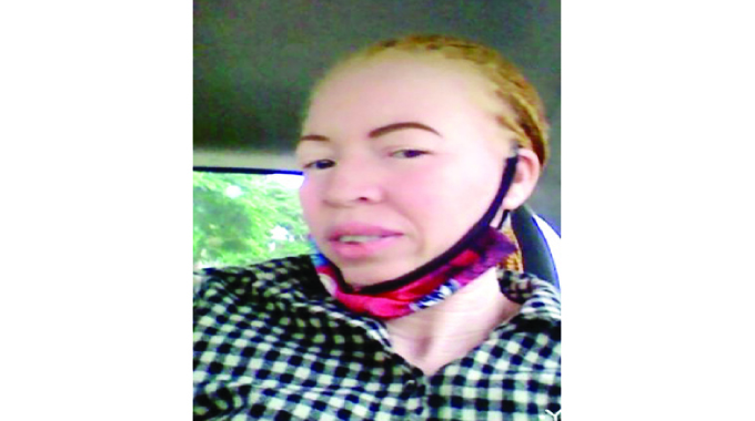Woman living with albinism narrates challenges