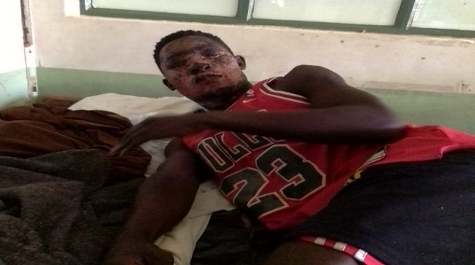 Burglars burnt with sulphuric acid- arrested while seeking medical attention